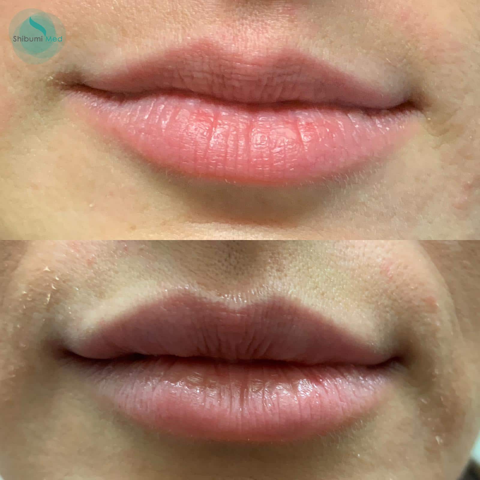 Filler Labbra frontale - Shibumi Med Torino