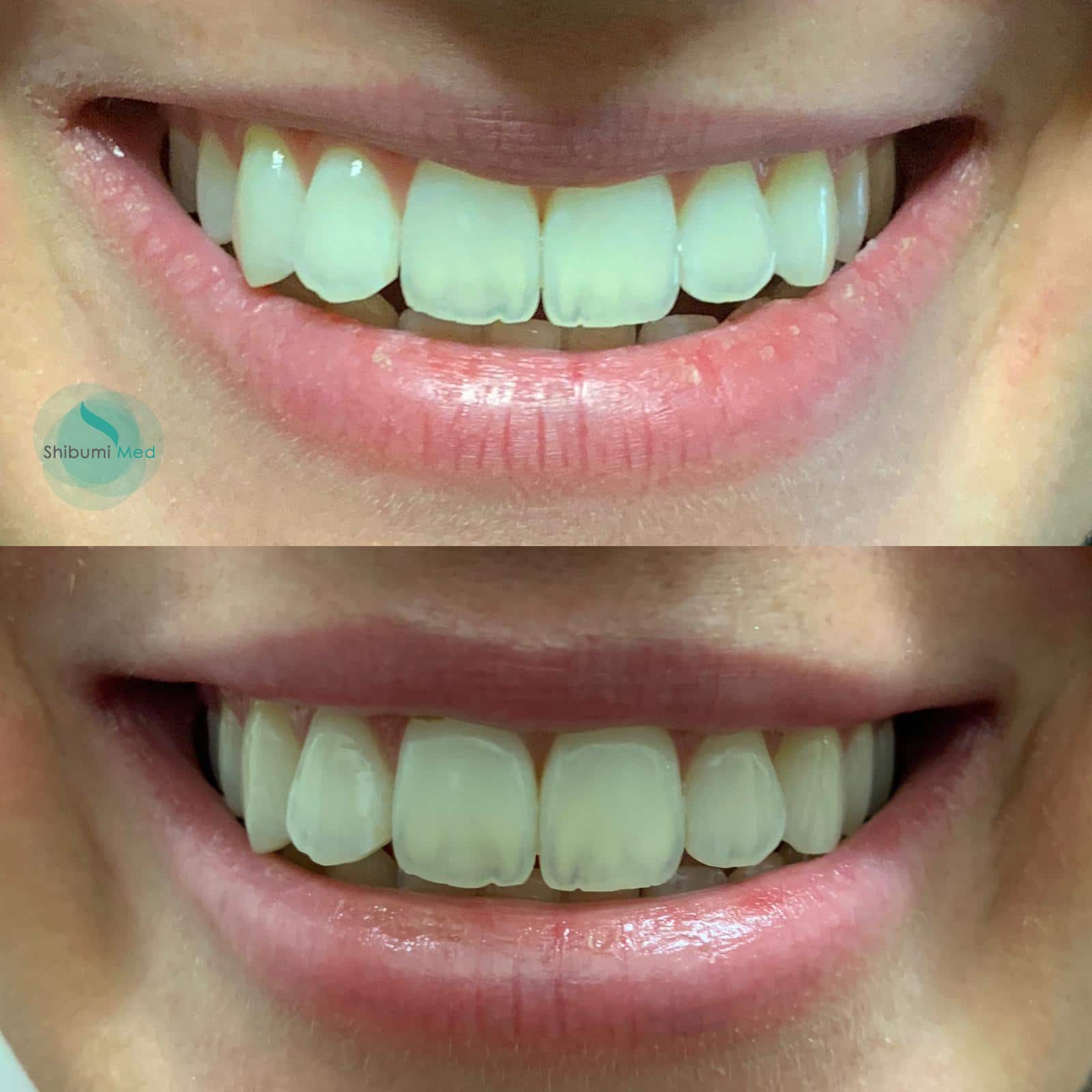 Filler Labbra sorriso - Shibumi Med Torino