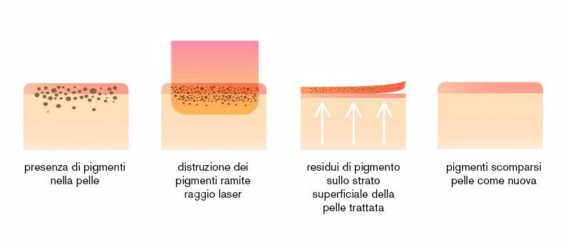 Rimozione Tatuaggi Laser Q Switched trattamento Shibumimed Torino