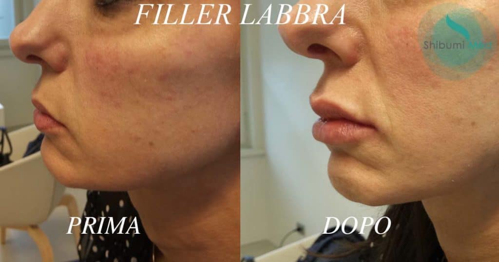 Shibumi – Filler Labbra Shibumi - Filler Labbra