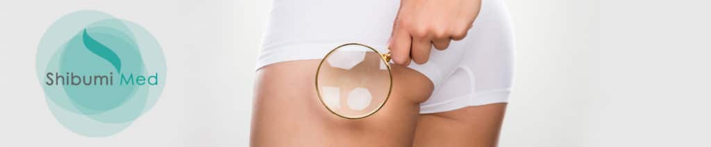 ShibumiMed_Mesoterapia-PEFS_Cellulite ShibumiMed_Mesoterapia-PEFS_Cellulite