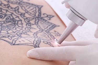 Rimozione tatuaggi tecnologia Laser Q switched Torino ShibumiMed